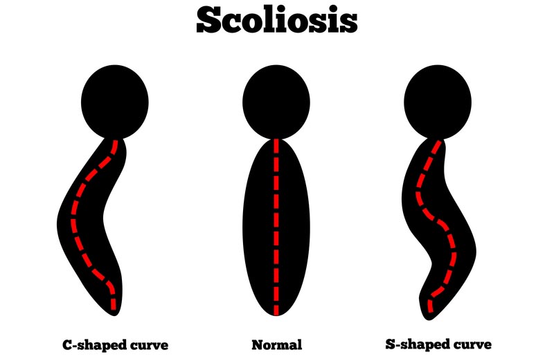 Hove, SXE scoliosis treatment